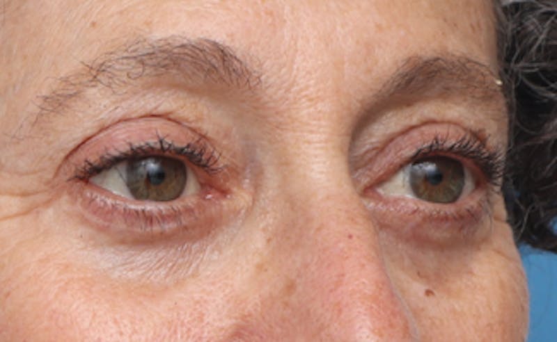 Eyelid Surgery Before & After Gallery - Patient 303461 - Image 6