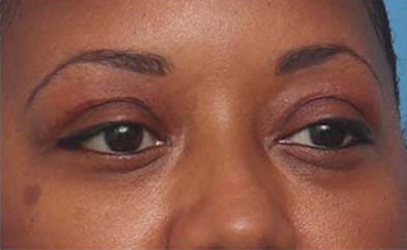 Eyelid Surgery Before & After Gallery - Patient 108834 - Image 4