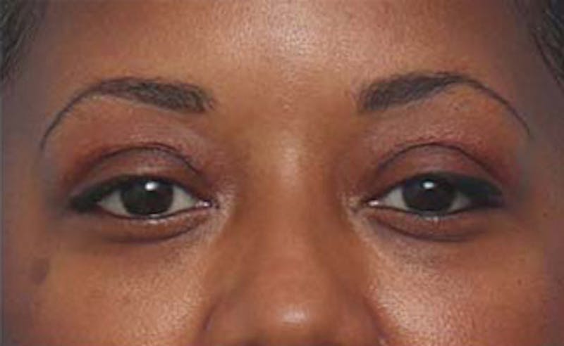 Eyelid Surgery Before & After Gallery - Patient 108834 - Image 2