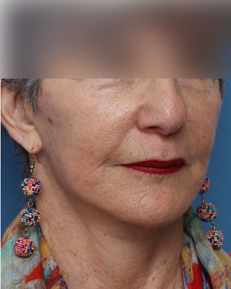 Facelift Before & After Gallery - Patient 385995 - Image 4
