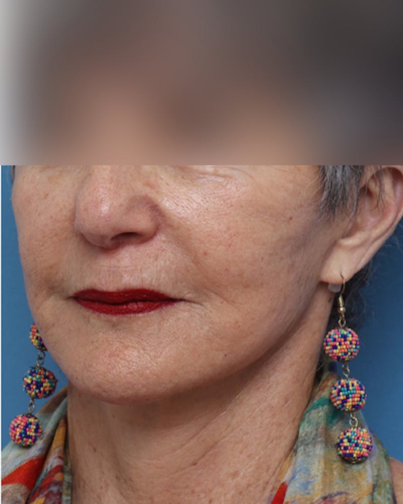 Facelift Before & After Gallery - Patient 385995 - Image 6