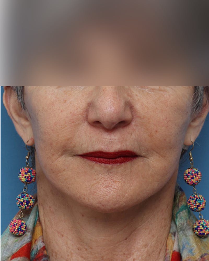 Facelift Before & After Gallery - Patient 385995 - Image 8