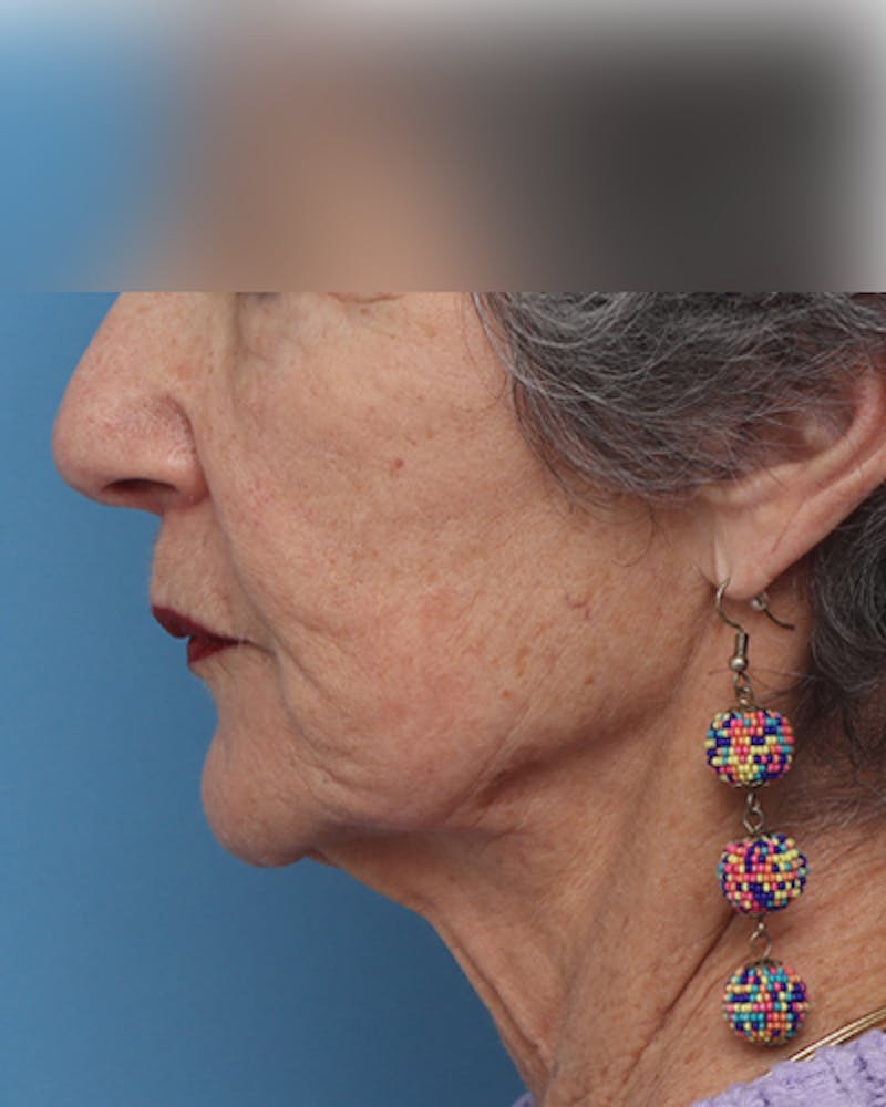 Facelift Before & After Gallery - Patient 385995 - Image 1