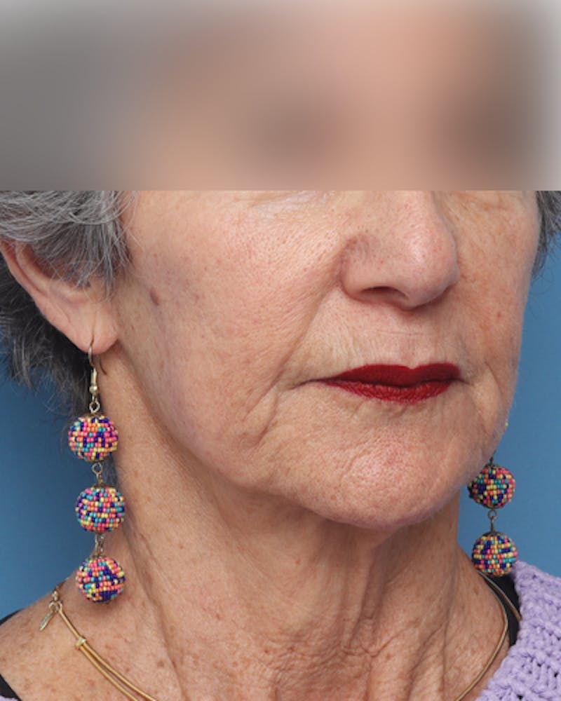 Facelift Before & After Gallery - Patient 385995 - Image 3