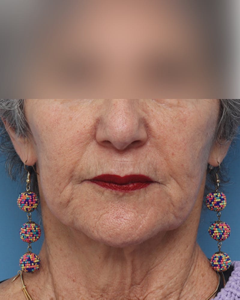 Facelift Before & After Gallery - Patient 385995 - Image 7