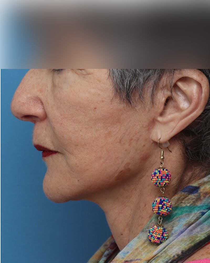 Facelift Before & After Gallery - Patient 385995 - Image 2