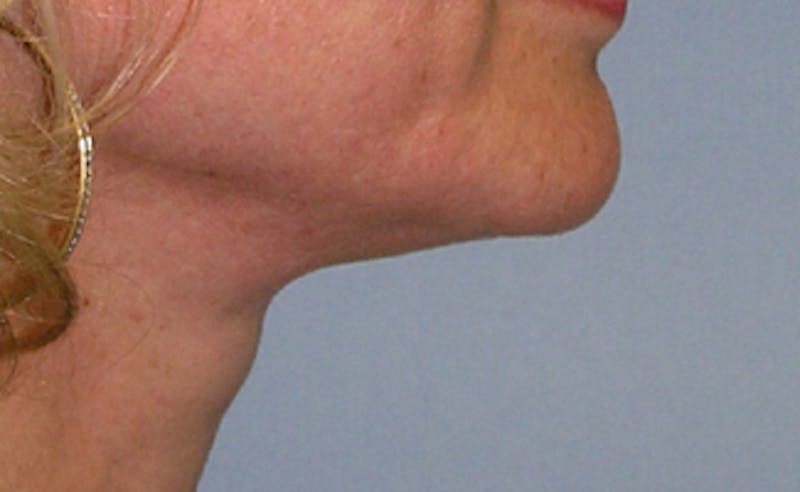 Neck Liposuction Before & After Gallery - Patient 176763 - Image 4