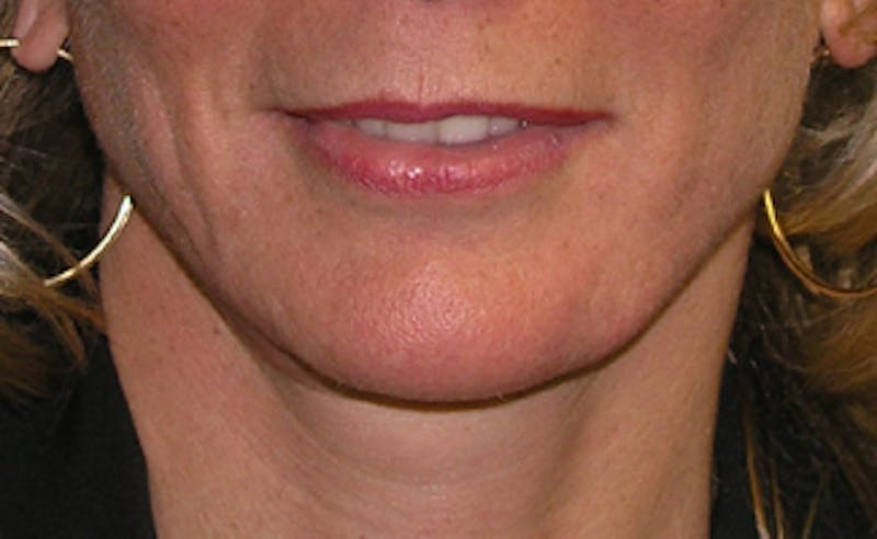 Jawline Contouring Before & After Gallery - Patient 354360 - Image 2
