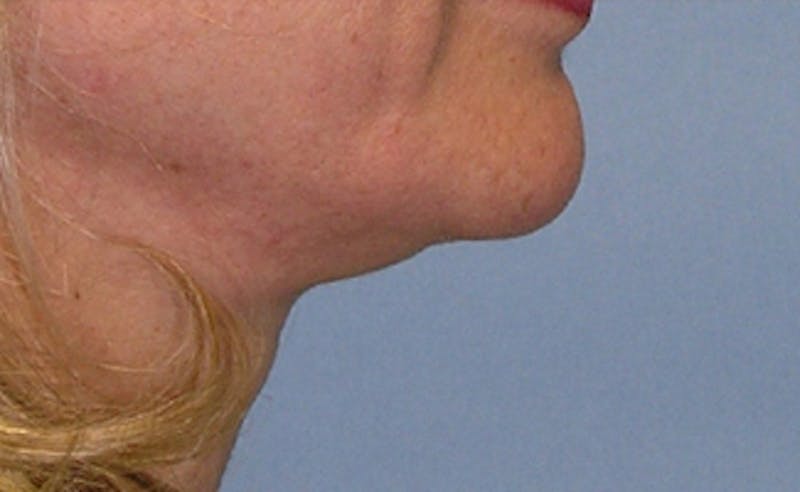 Neck Liposuction Before & After Gallery - Patient 176763 - Image 3
