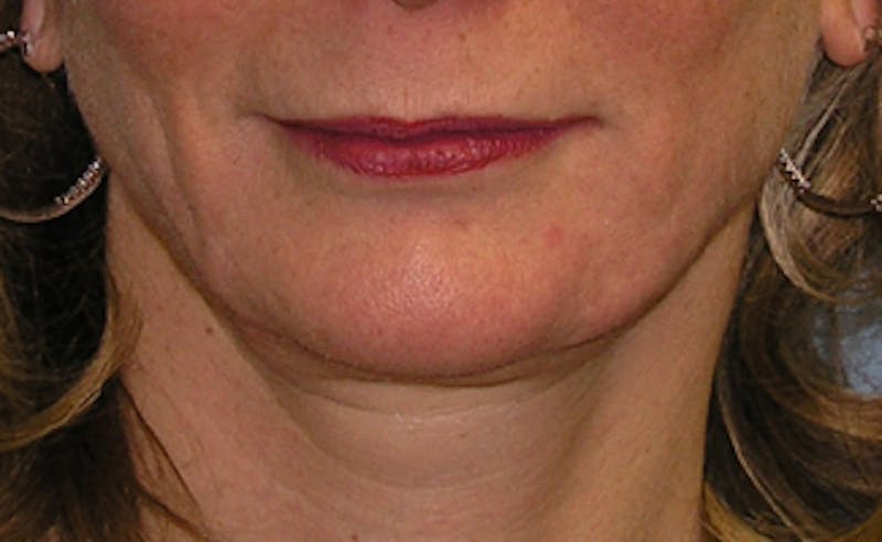 Patient PqlCYy7cReySqc7MgJXkAw - Jawline Contouring Before & After Photos