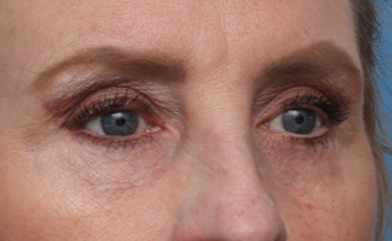Eyelid Surgery Before & After Gallery - Patient 187680 - Image 6