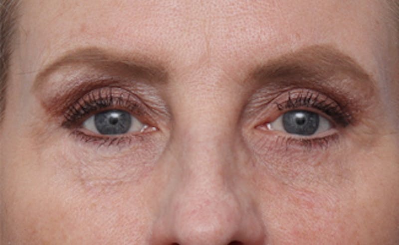 Eyelid Surgery Before & After Gallery - Patient 187680 - Image 2