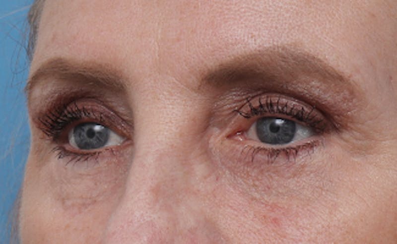 Eyelid Surgery Before & After Gallery - Patient 187680 - Image 4