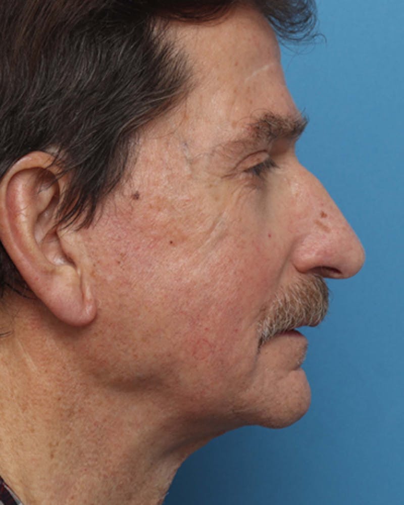Facelift Before & After Gallery - Patient 425673 - Image 4
