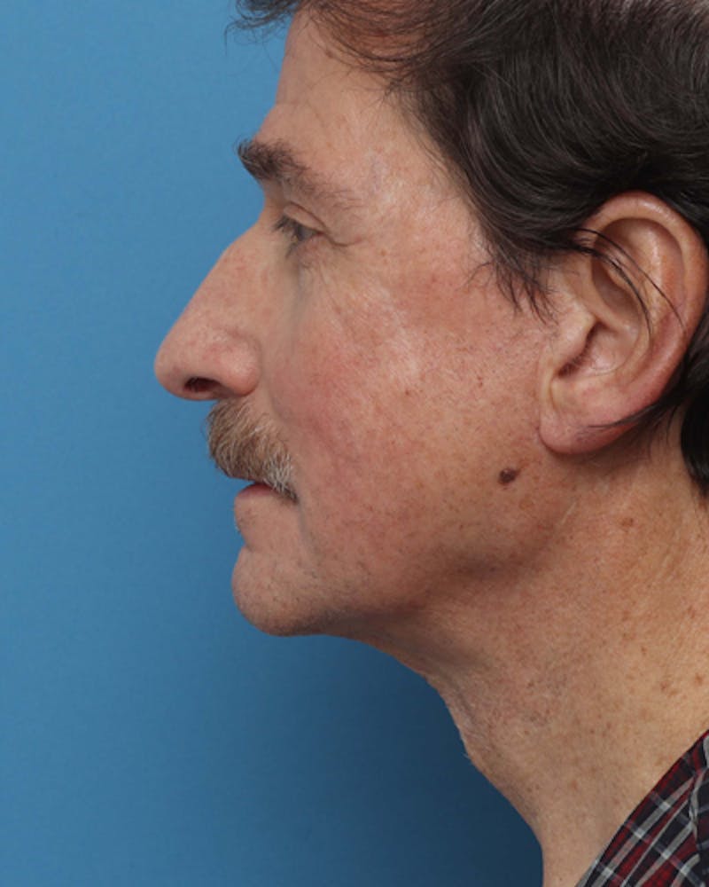 Jawline Contouring Before & After Gallery - Patient 381944 - Image 2