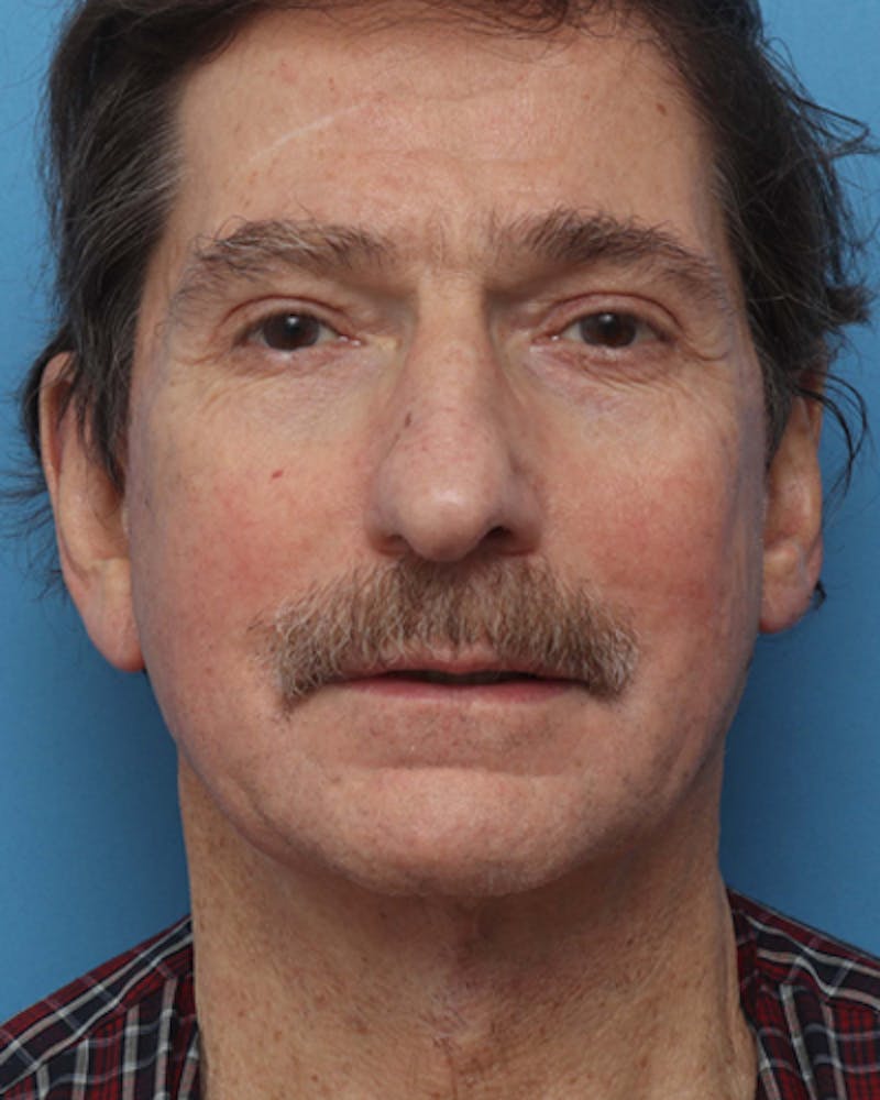 Facelift Before & After Gallery - Patient 425673 - Image 6