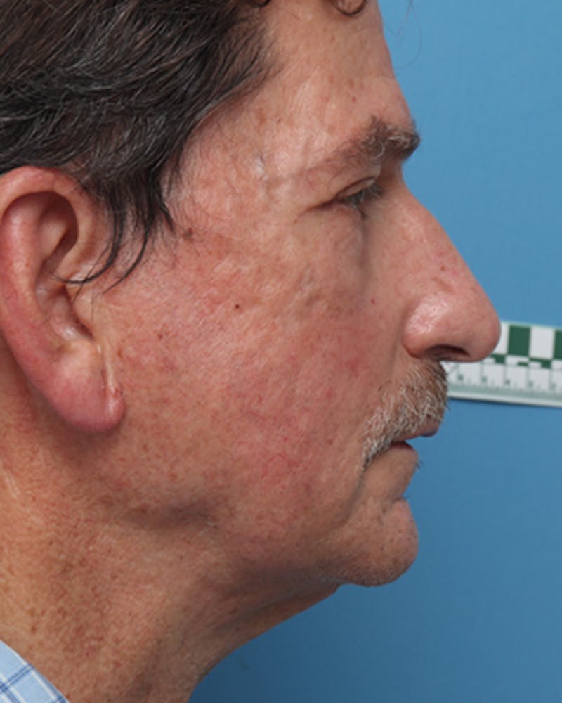 Facelift Before & After Gallery - Patient 425673 - Image 3