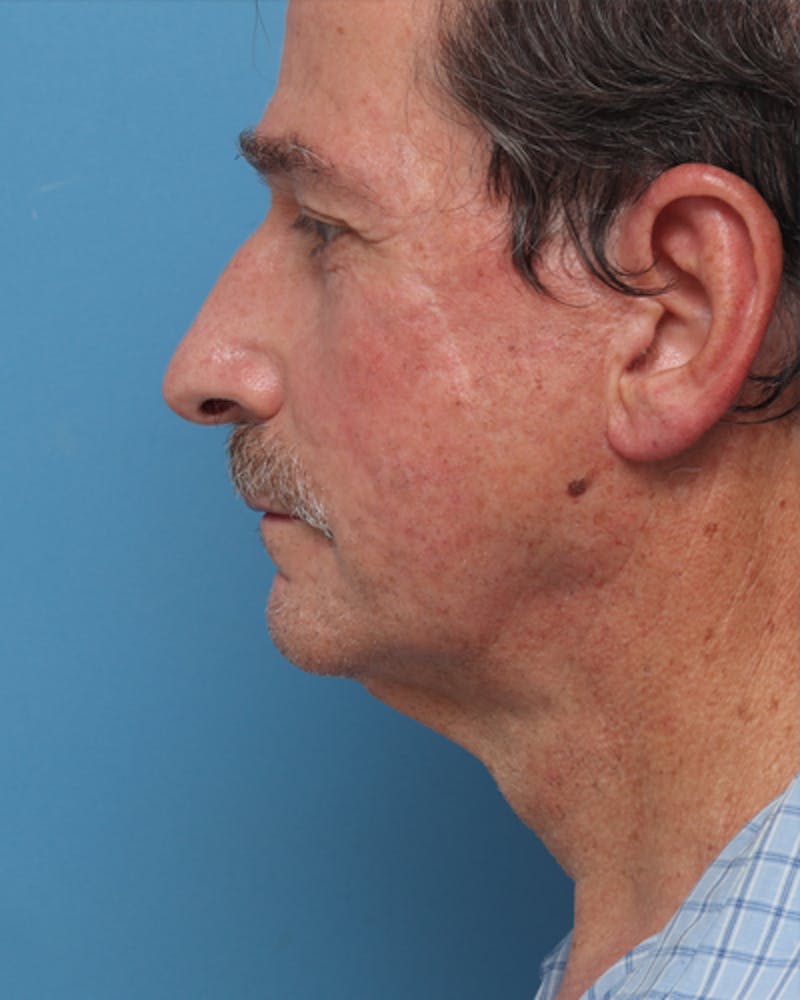 Patient QwvGTUgVRTW4wiQSO9ROcg - Jawline Contouring Before & After Photos