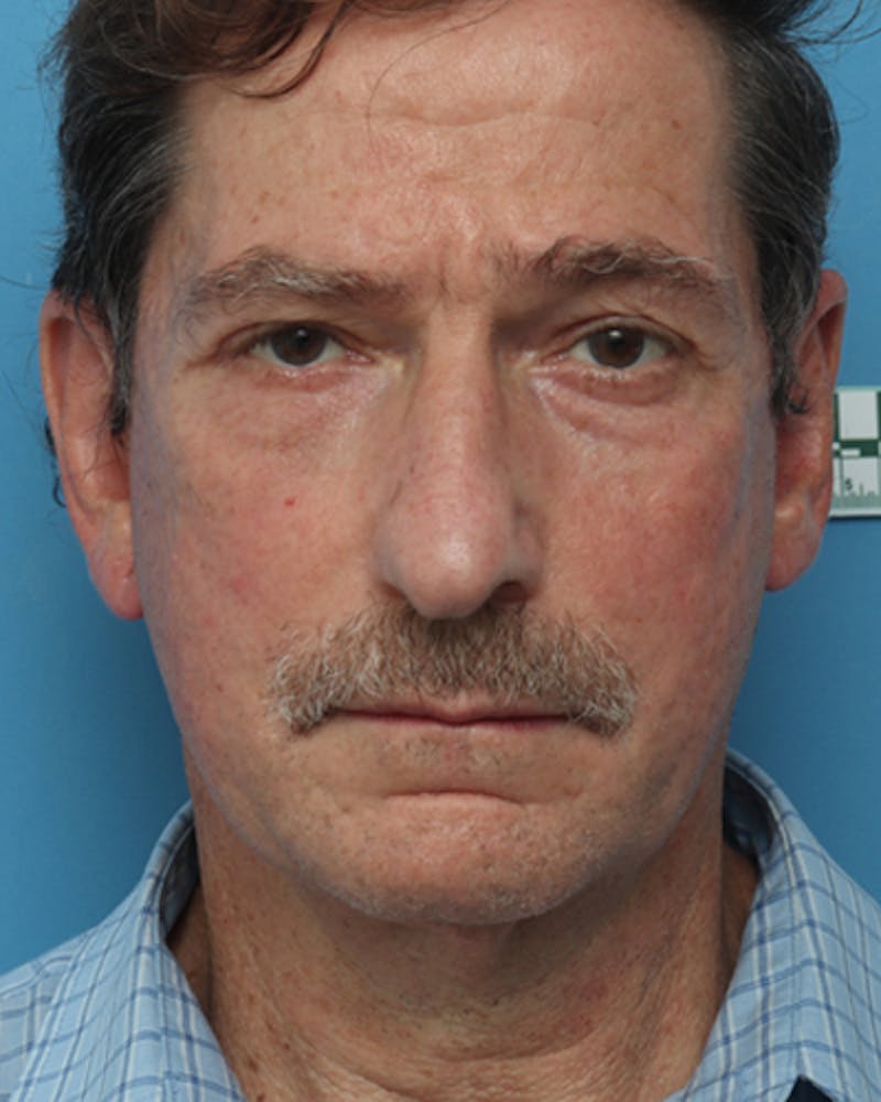 Facelift Before & After Gallery - Patient 425673 - Image 5