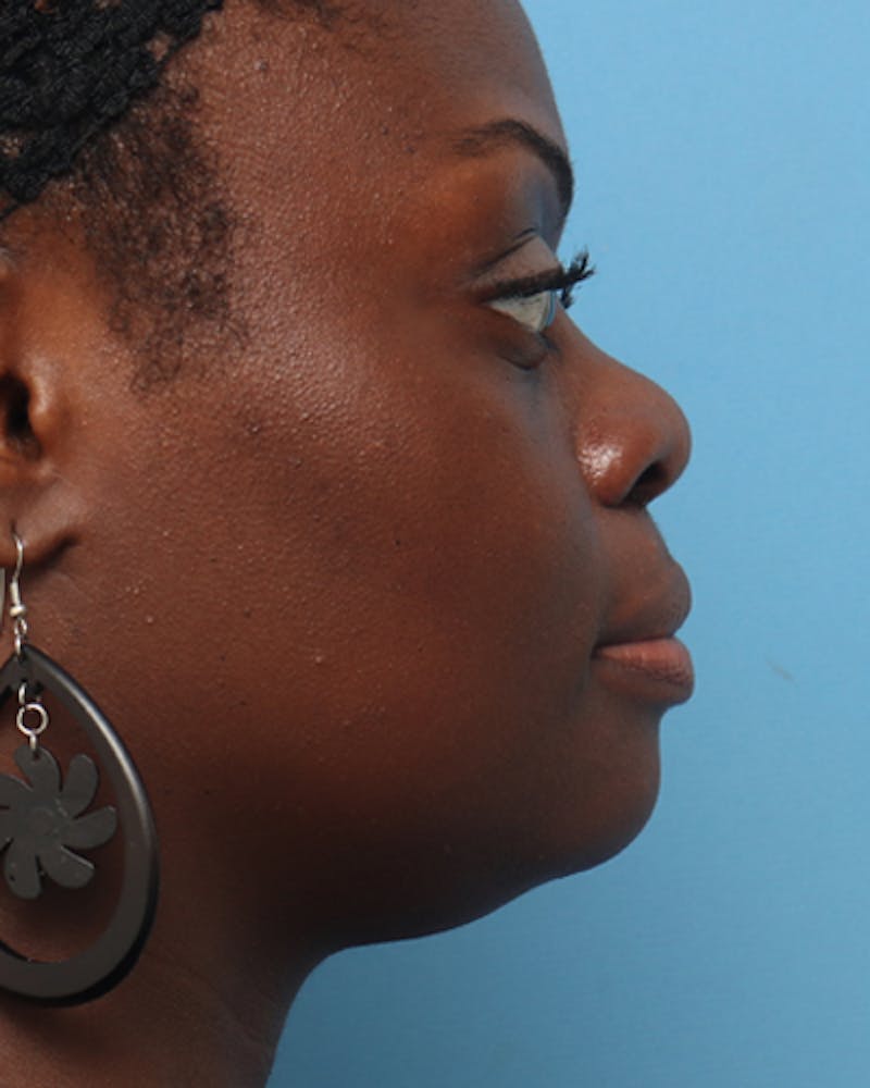 Patient UPwYX3PSQwqi2-DI24FiQg - Neck Liposuction Before & After Photos