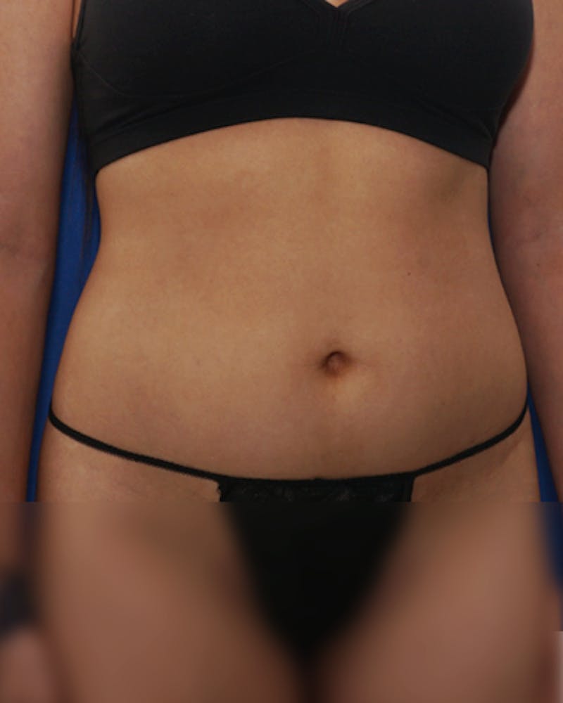 Liposuction (Body) Before & After Gallery - Patient 255887 - Image 4