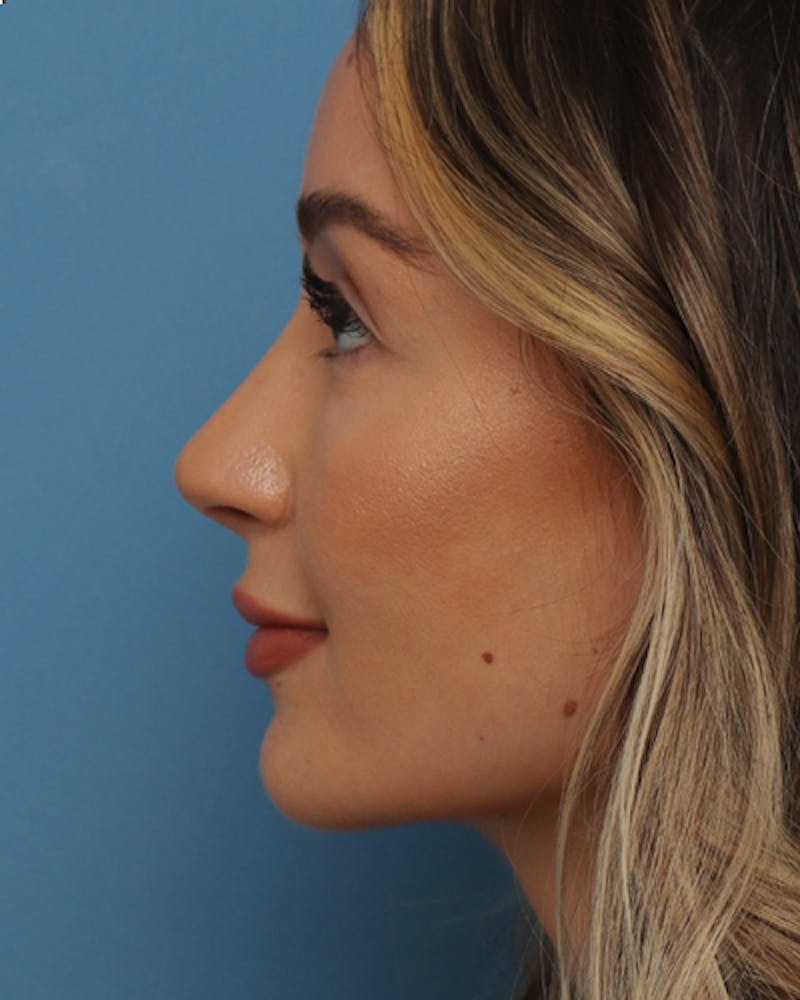 Rhinoplasty Before & After Gallery - Patient 272759 - Image 2