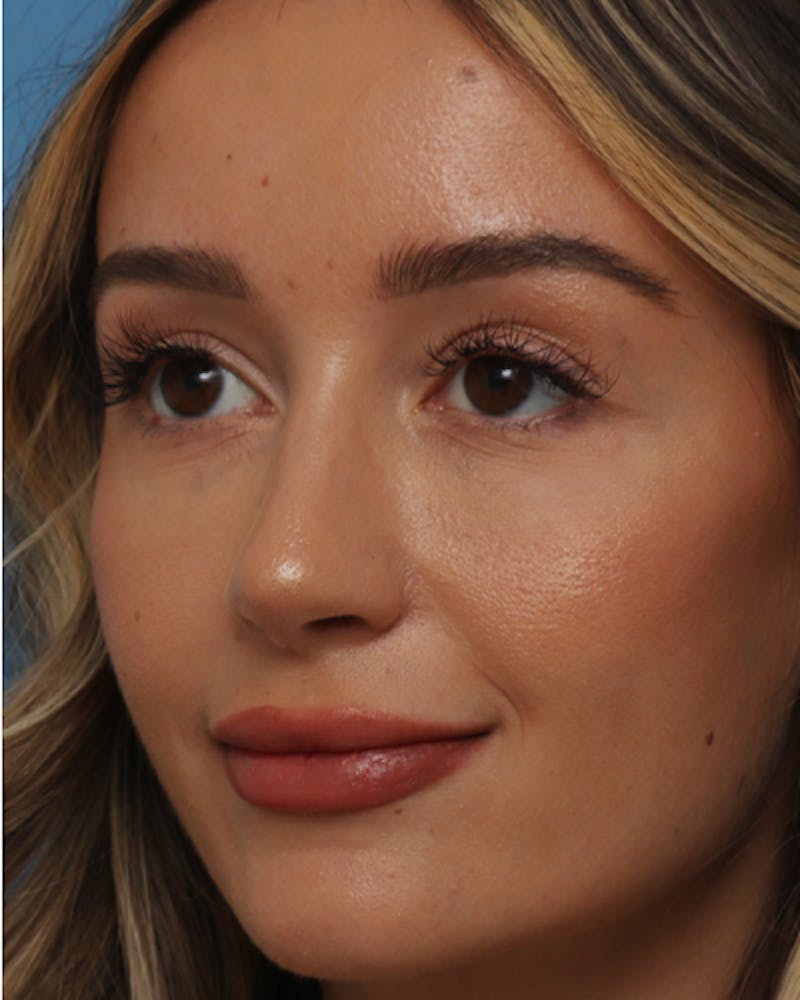 Rhinoplasty  Before & After Gallery - Patient 166528 - Image 4