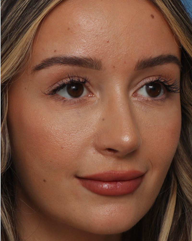 Rhinoplasty  Before & After Gallery - Patient 166528 - Image 8