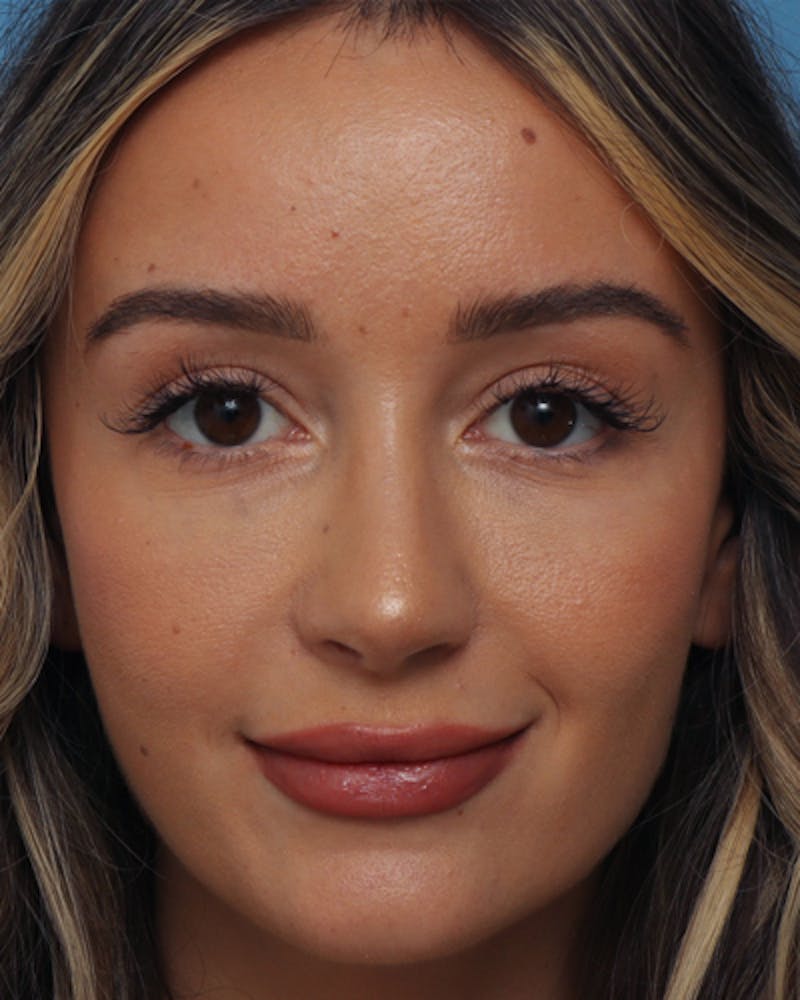Rhinoplasty  Before & After Gallery - Patient 166528 - Image 6