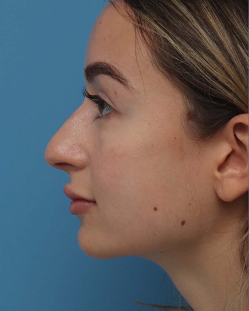 Patient B4HvjQyaREWUZgJ6rgEepw - Rhinoplasty Before & After Photos