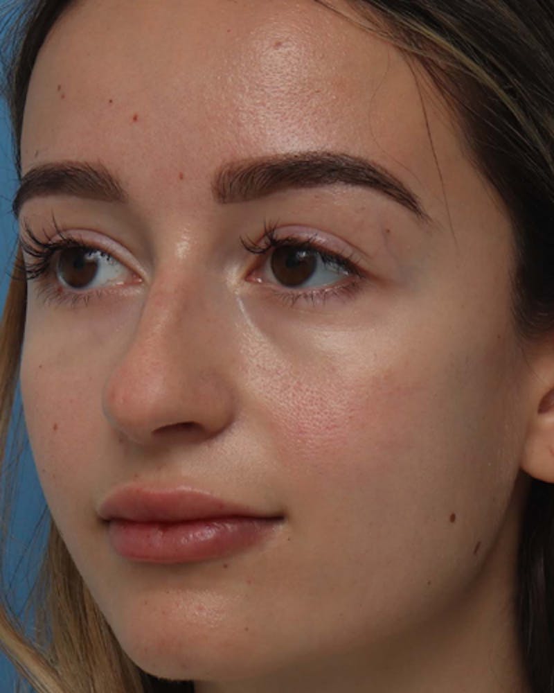 Rhinoplasty  Before & After Gallery - Patient 166528 - Image 3