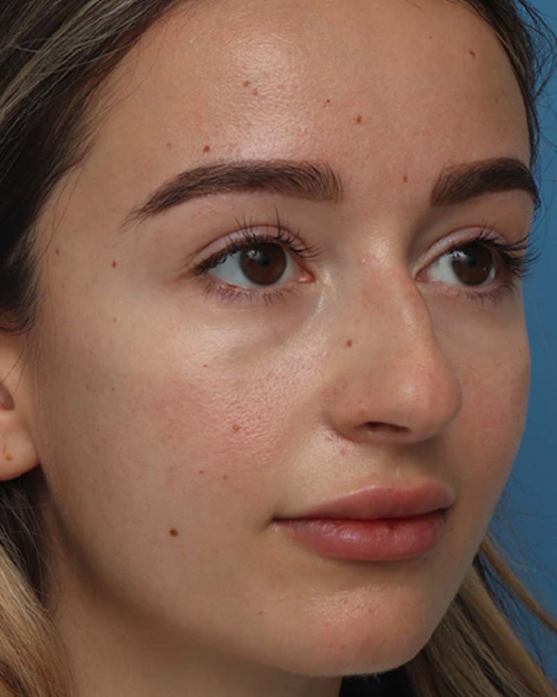 Rhinoplasty  Before & After Gallery - Patient 166528 - Image 7