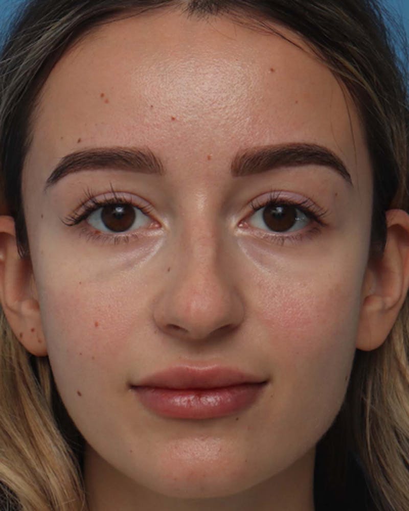 Rhinoplasty  Before & After Gallery - Patient 166528 - Image 5
