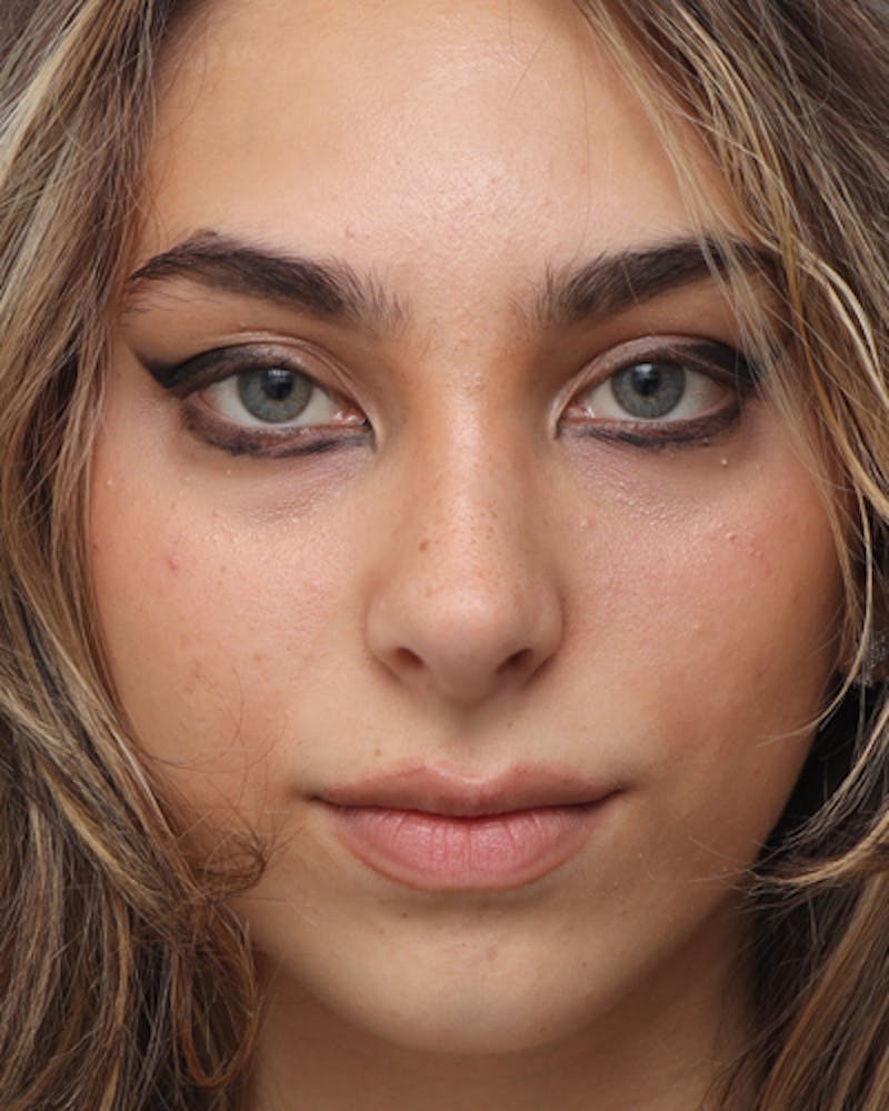 Rhinoplasty  Before & After Gallery - Patient 284839 - Image 4