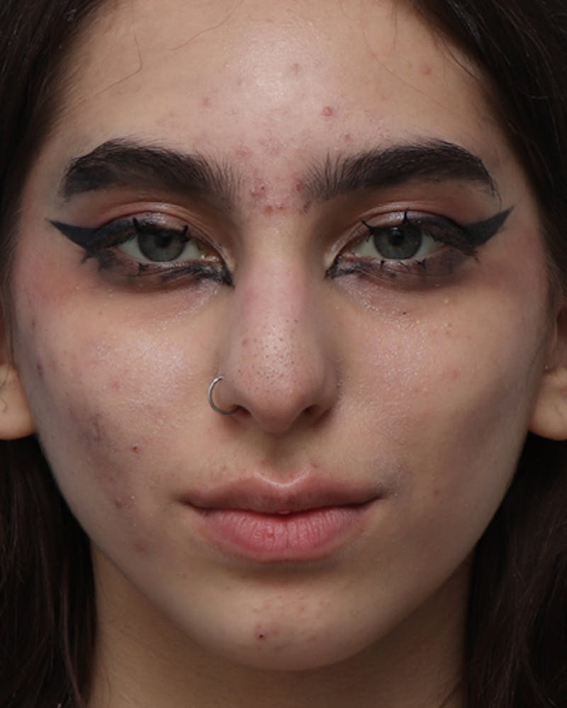 Rhinoplasty  Before & After Gallery - Patient 284839 - Image 3