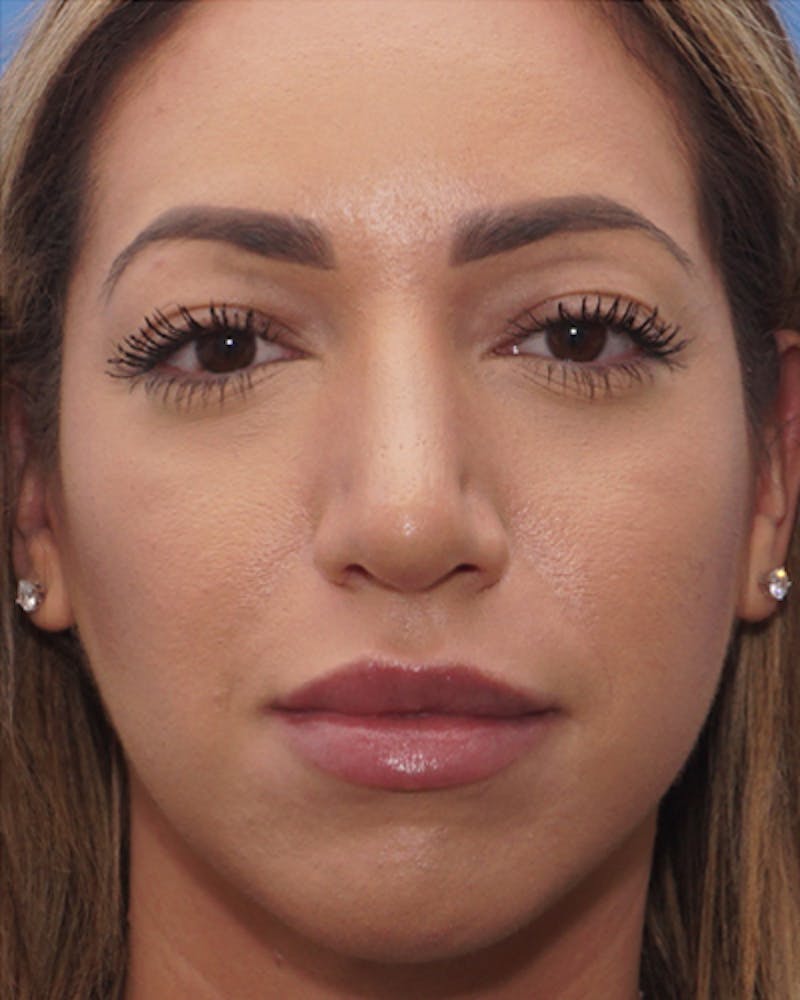 Favorite Ethnic Rhinoplasty Before & After Gallery - Patient 118498 - Image 4