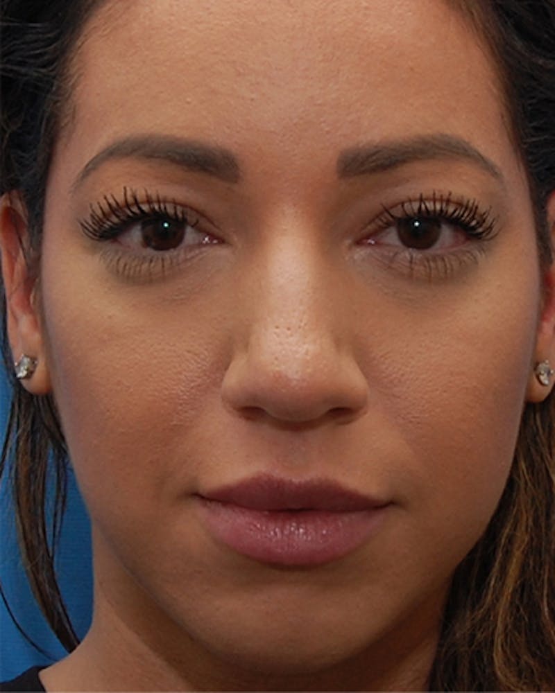Favorite Ethnic Rhinoplasty Before & After Gallery - Patient 118498 - Image 3