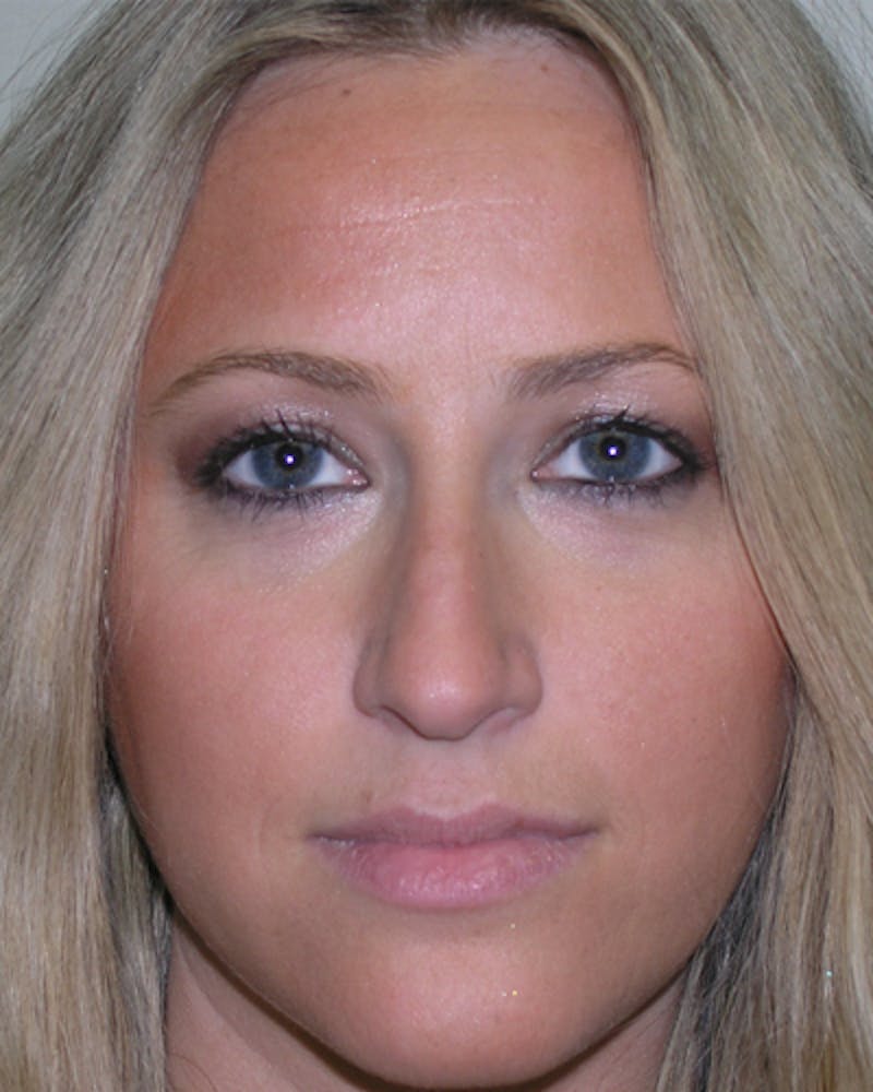 Rhinoplasty  Before & After Gallery - Patient 429432 - Image 3