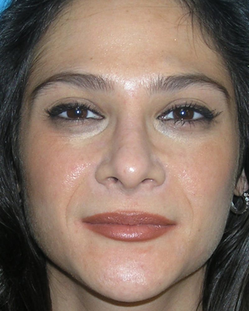 Rhinoplasty  Before & After Gallery - Patient 286006 - Image 7