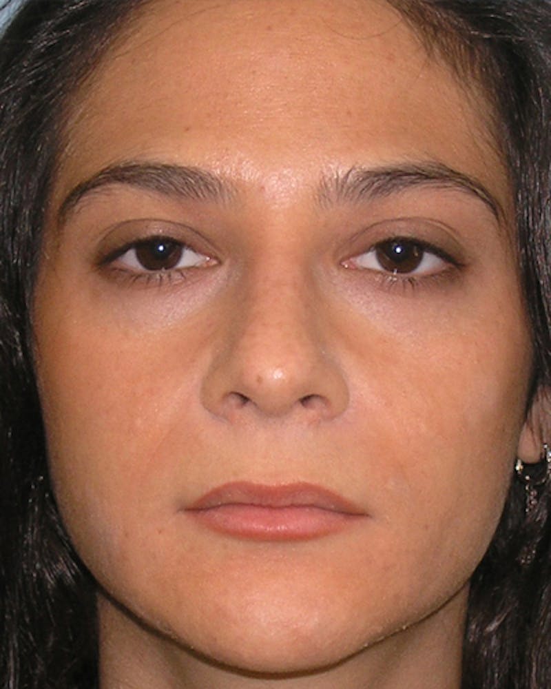 Rhinoplasty  Before & After Gallery - Patient 286006 - Image 8