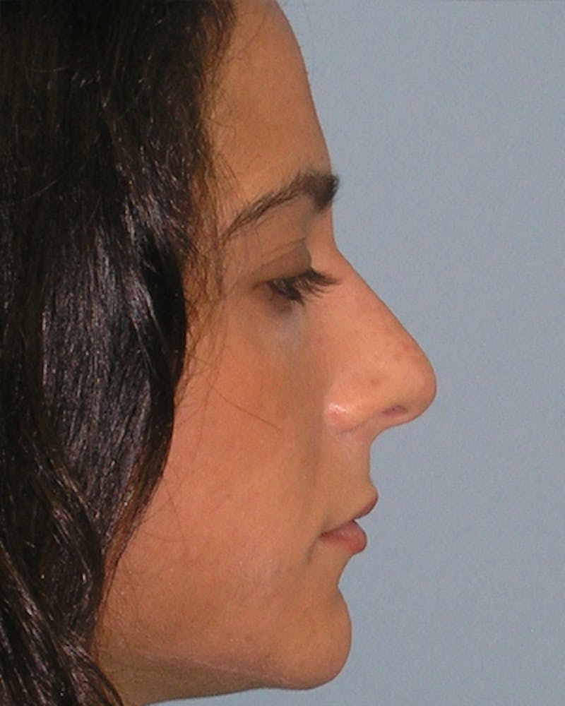 Patient c7FJHgulSMaAnT2Rp4-tJg - Rhinoplasty Before & After Photos