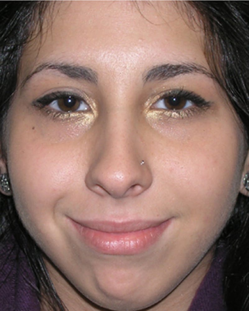 Rhinoplasty  Before & After Gallery - Patient 175026 - Image 4