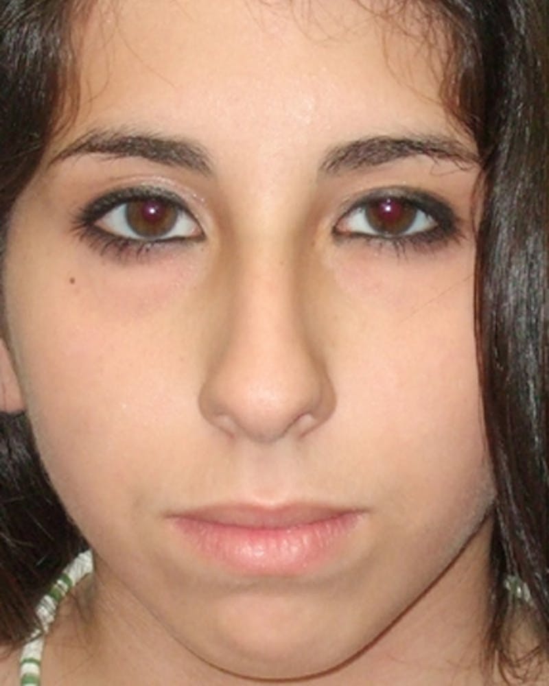 Rhinoplasty  Before & After Gallery - Patient 175026 - Image 3