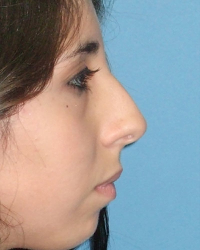 Patient eBSjQAJeQ3afWMh5pKqIhQ - Rhinoplasty Before & After Photos