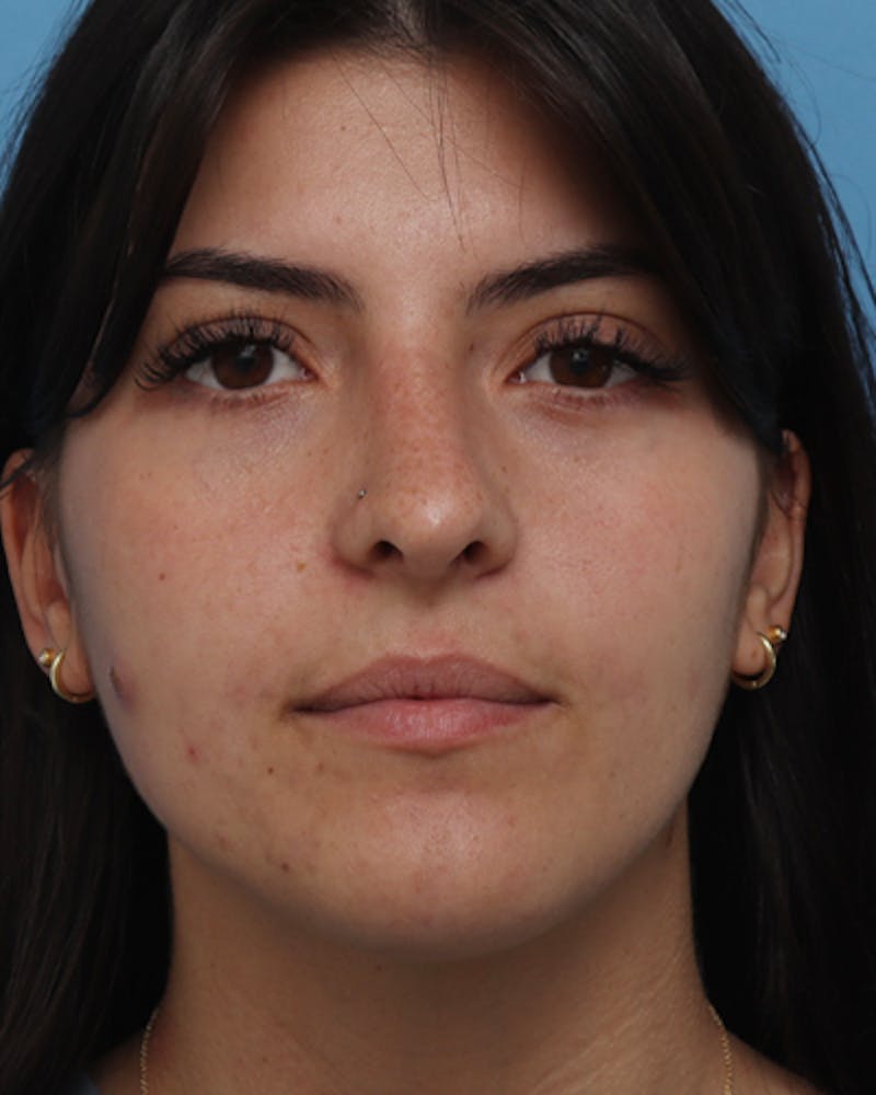 Rhinoplasty  Before & After Gallery - Patient 276744 - Image 4