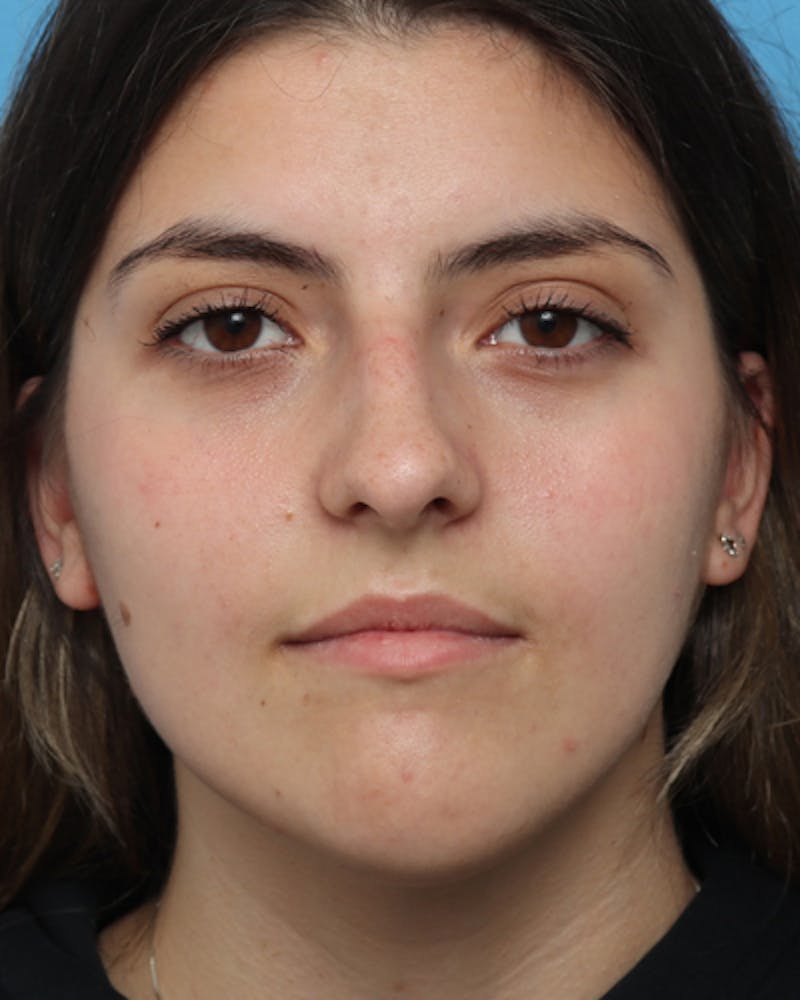 Rhinoplasty  Before & After Gallery - Patient 276744 - Image 3