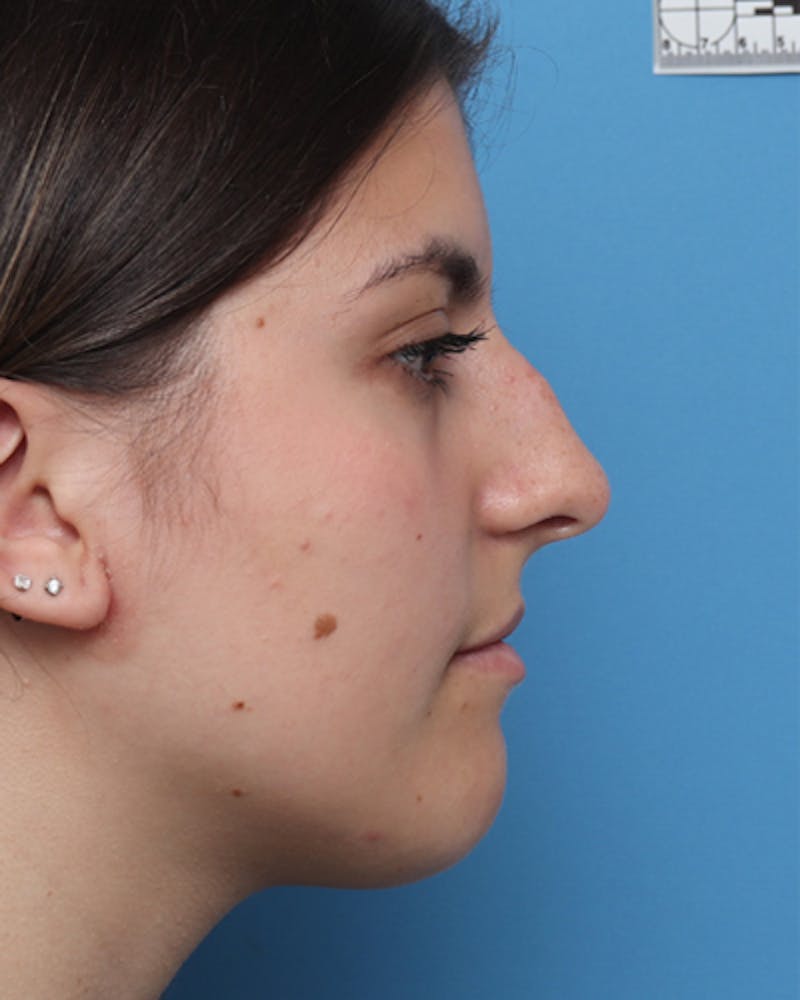Patient SIiwnpLrTIqpjbEvylUOiQ - Rhinoplasty Before & After Photos