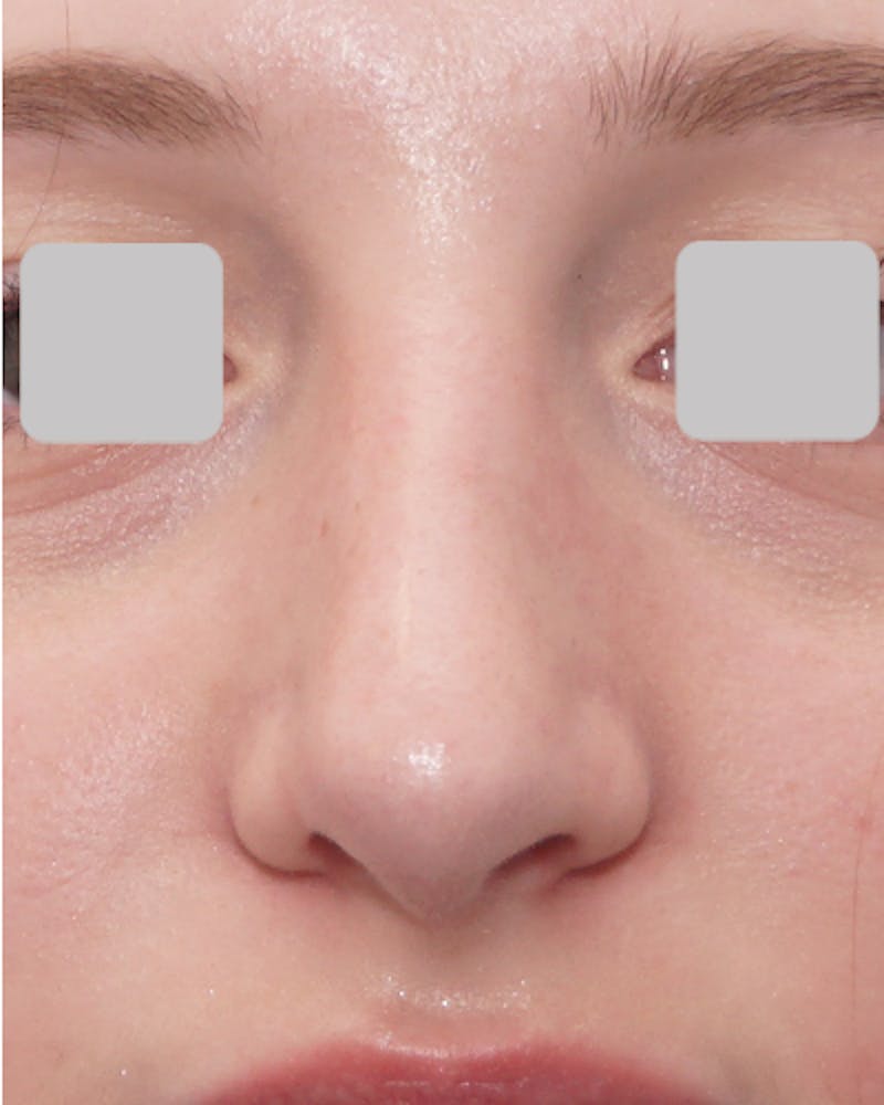 Rhinoplasty  Before & After Gallery - Patient 418933 - Image 4