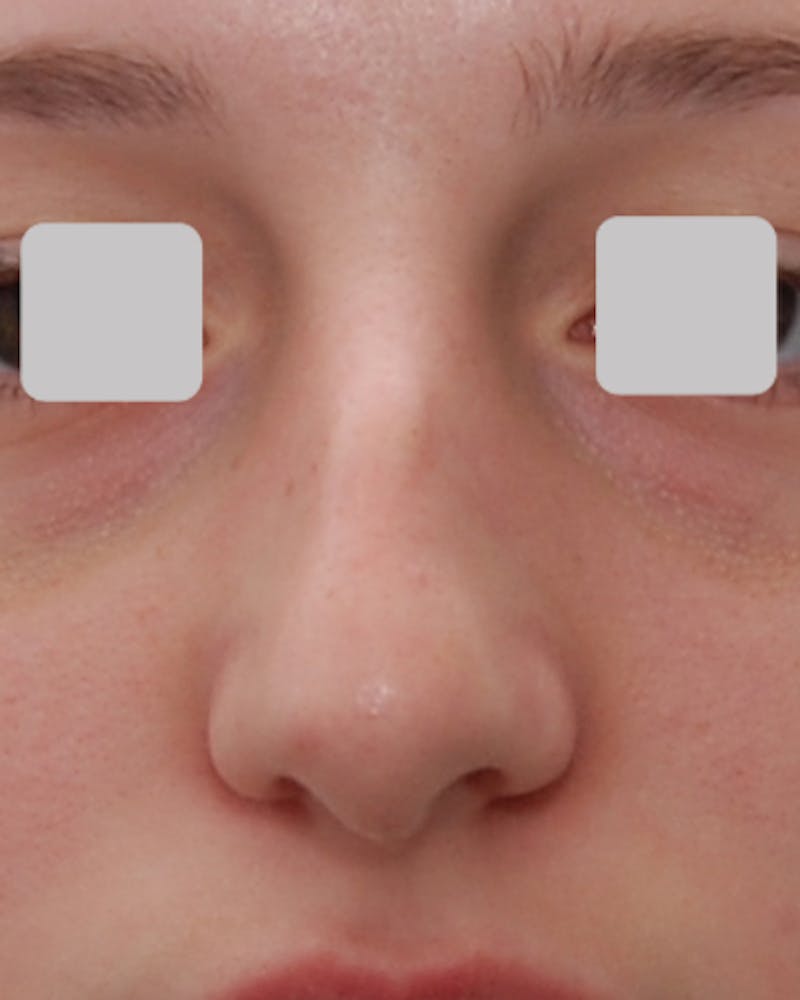 Rhinoplasty  Before & After Gallery - Patient 418933 - Image 3