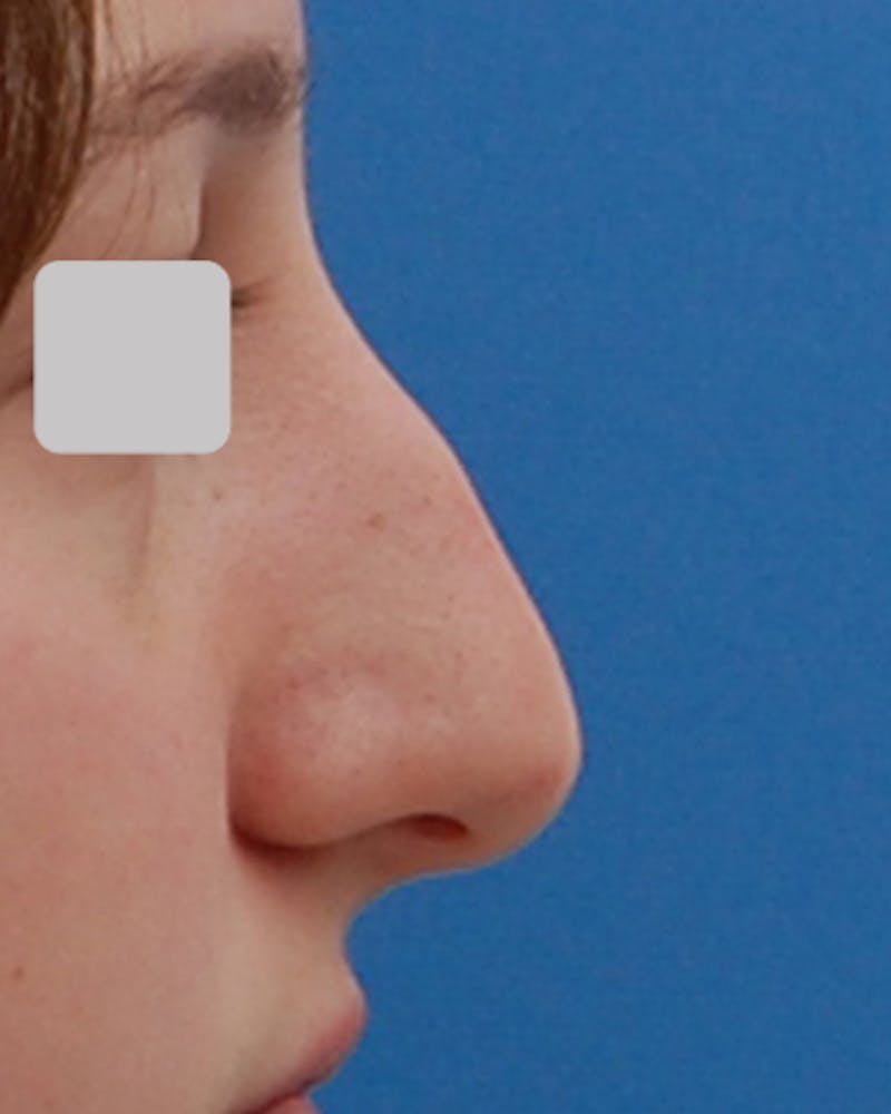 Patient OkOx2BWGRWiPpPpQOT82qQ - Rhinoplasty Before & After Photos